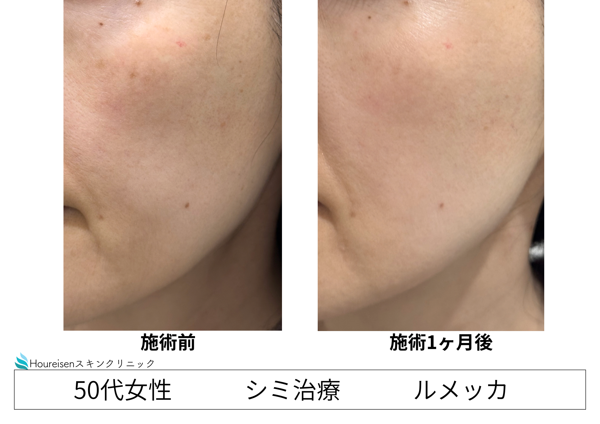ルメッカ（フォトフェイシャル）照射で美容未経験の肌はどう変わる？　50代女性症例④の症例写真