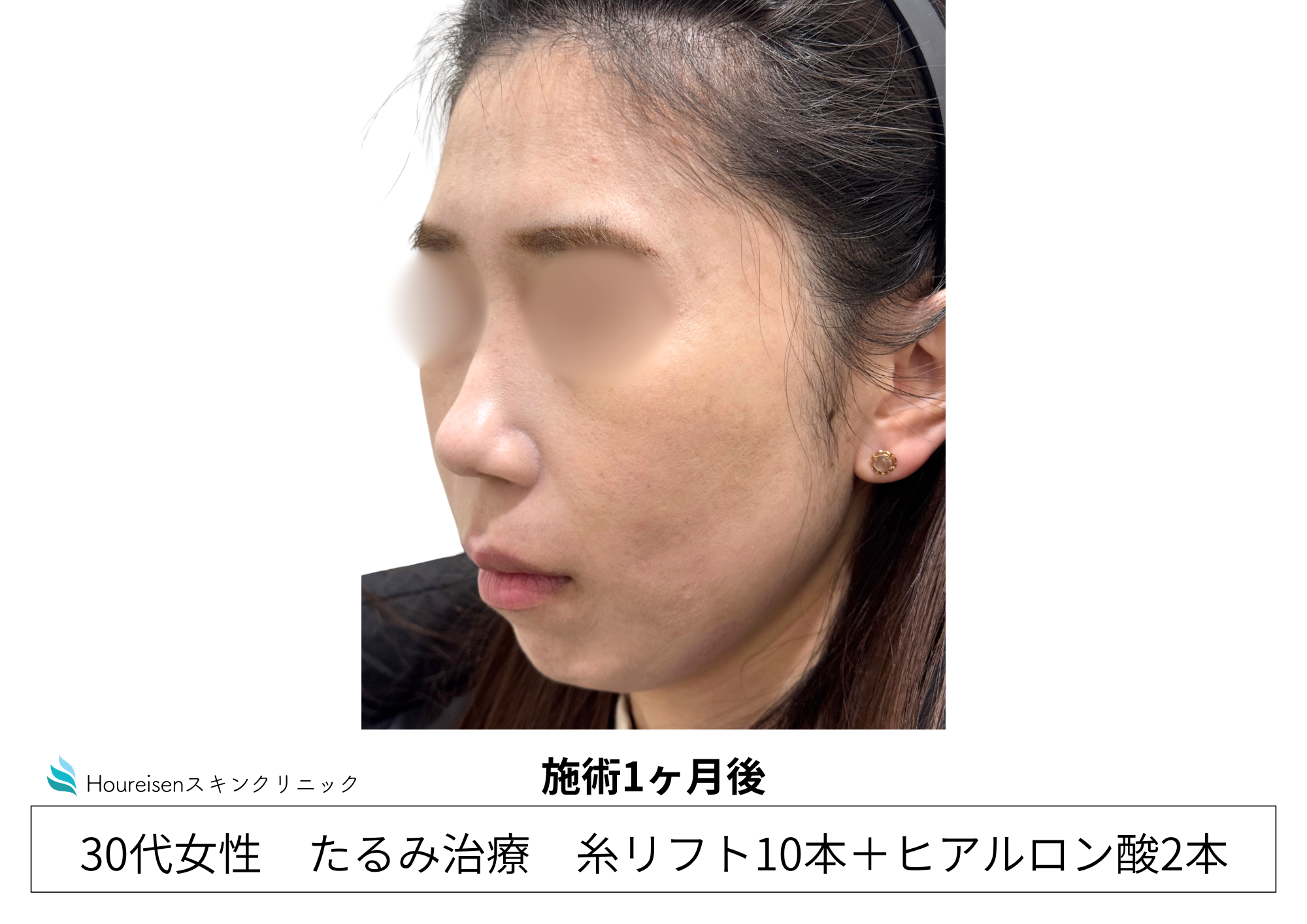 30代女性の糸リフトとヒアルロン酸施術1か月後 左側