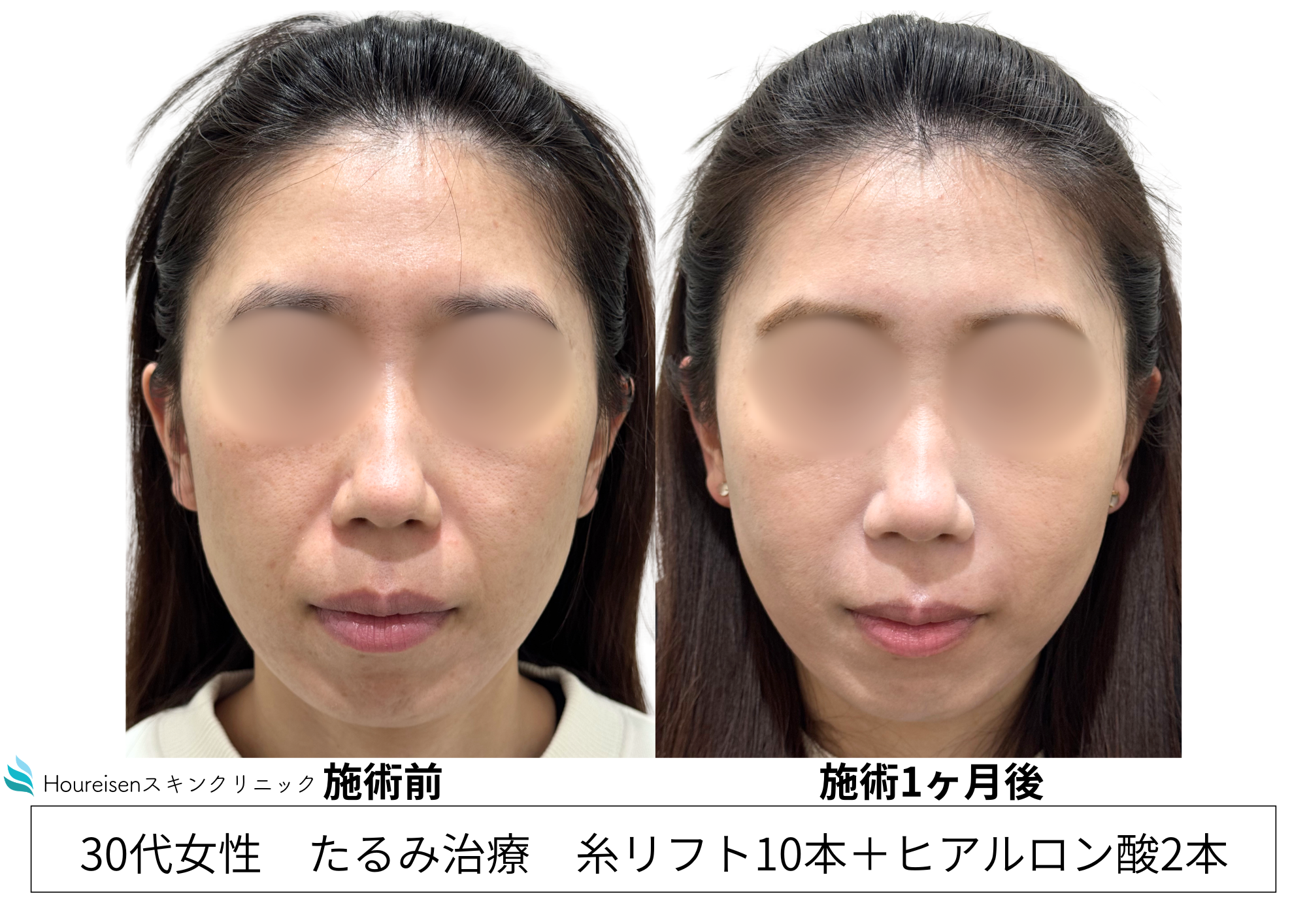 ほうれい線の原因は“頬の下垂”｜糸リフト＋ヒアルロン酸で改善　30代女性症例㉟の症例写真