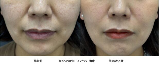 40代女性 症例54のほうれい線治療写真