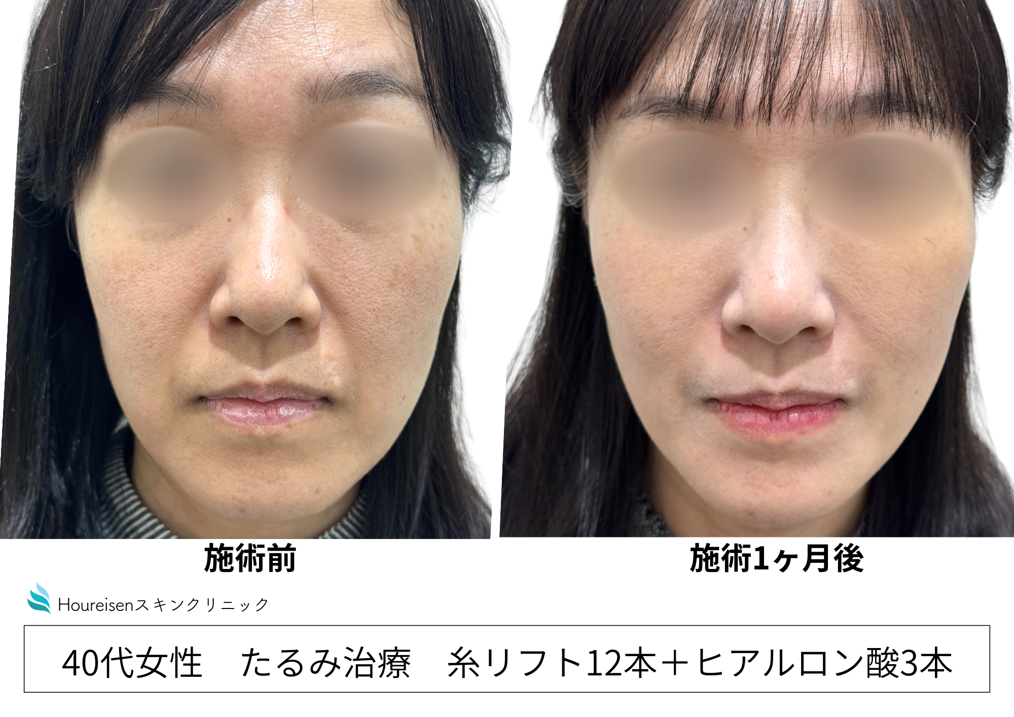 糸リフト＋ヒアルロン酸で頬のたるみ・ほうれい線の改善を行った経過　40代女性症例㉕の症例写真