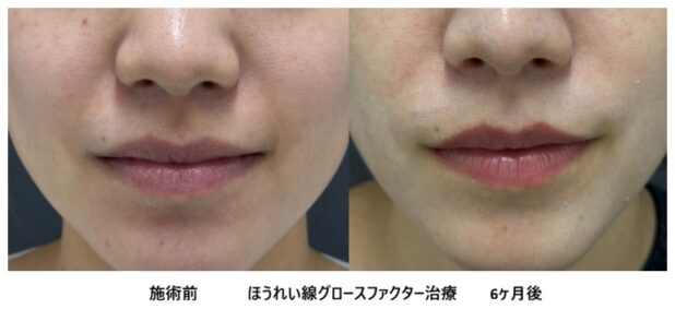 20代女性 症例21のほうれい線治療写真