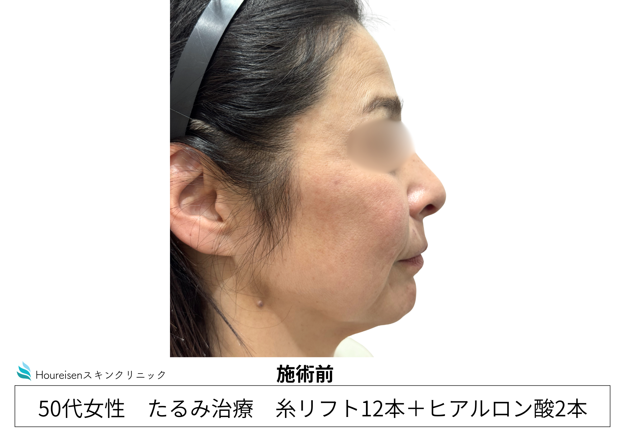 他院糸リフト歴がある50代女性の施術前 右側別角度