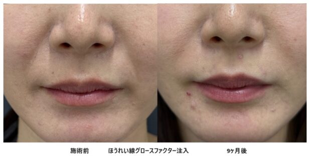 30代女性 症例56のほうれい線治療写真