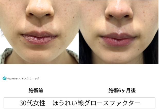 30代女性 症例43のほうれい線治療写真