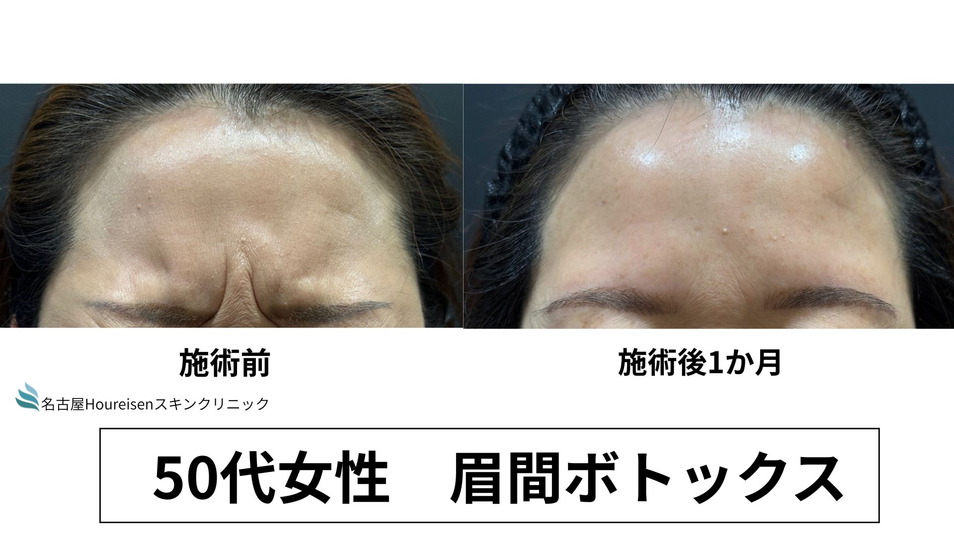 【名古屋】眉間のシワで不機嫌に見える方へ｜ボトックスで自然に印象改善（1ヶ月症例）の症例写真