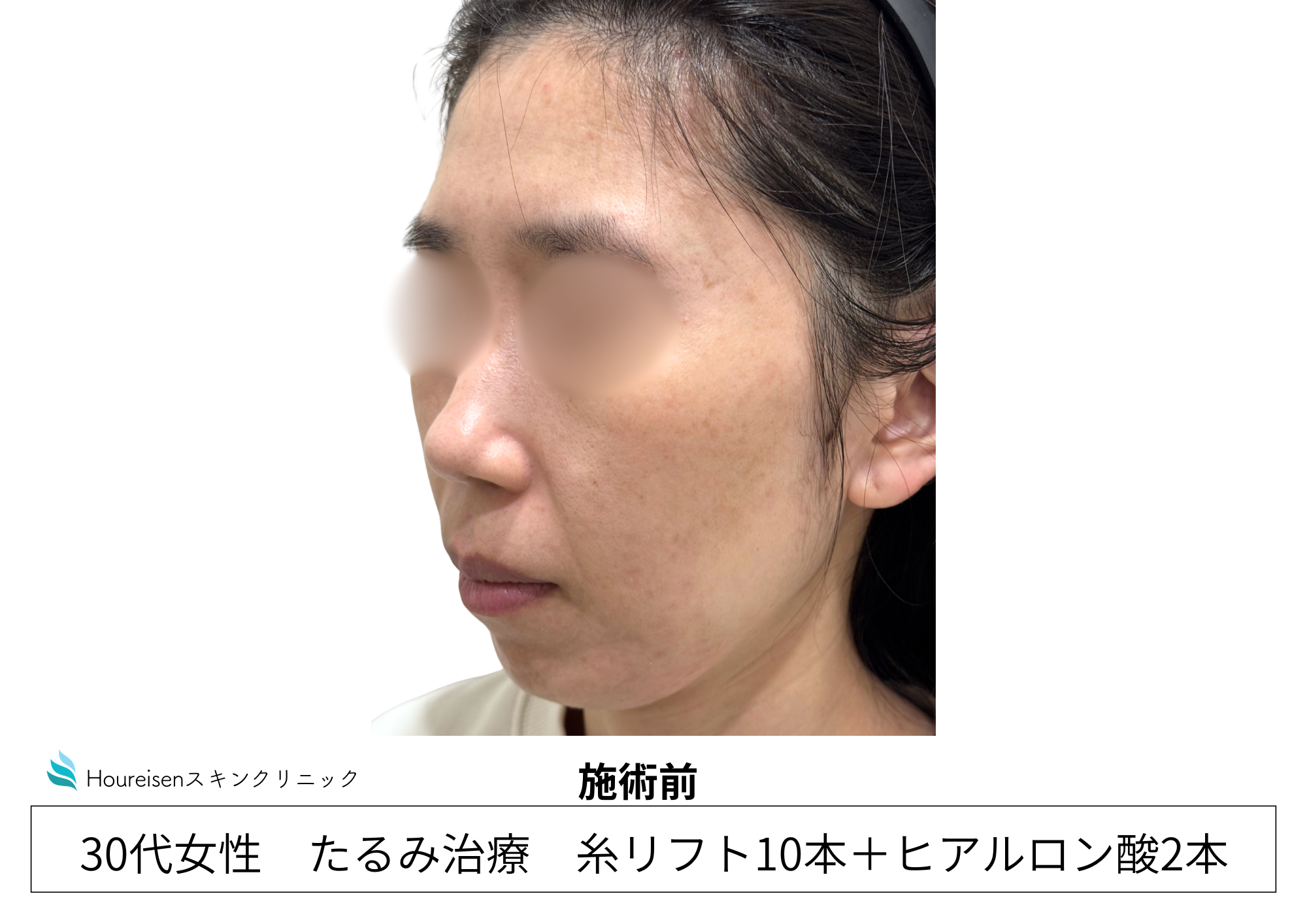 30代女性の糸リフトとヒアルロン酸施術前 左側