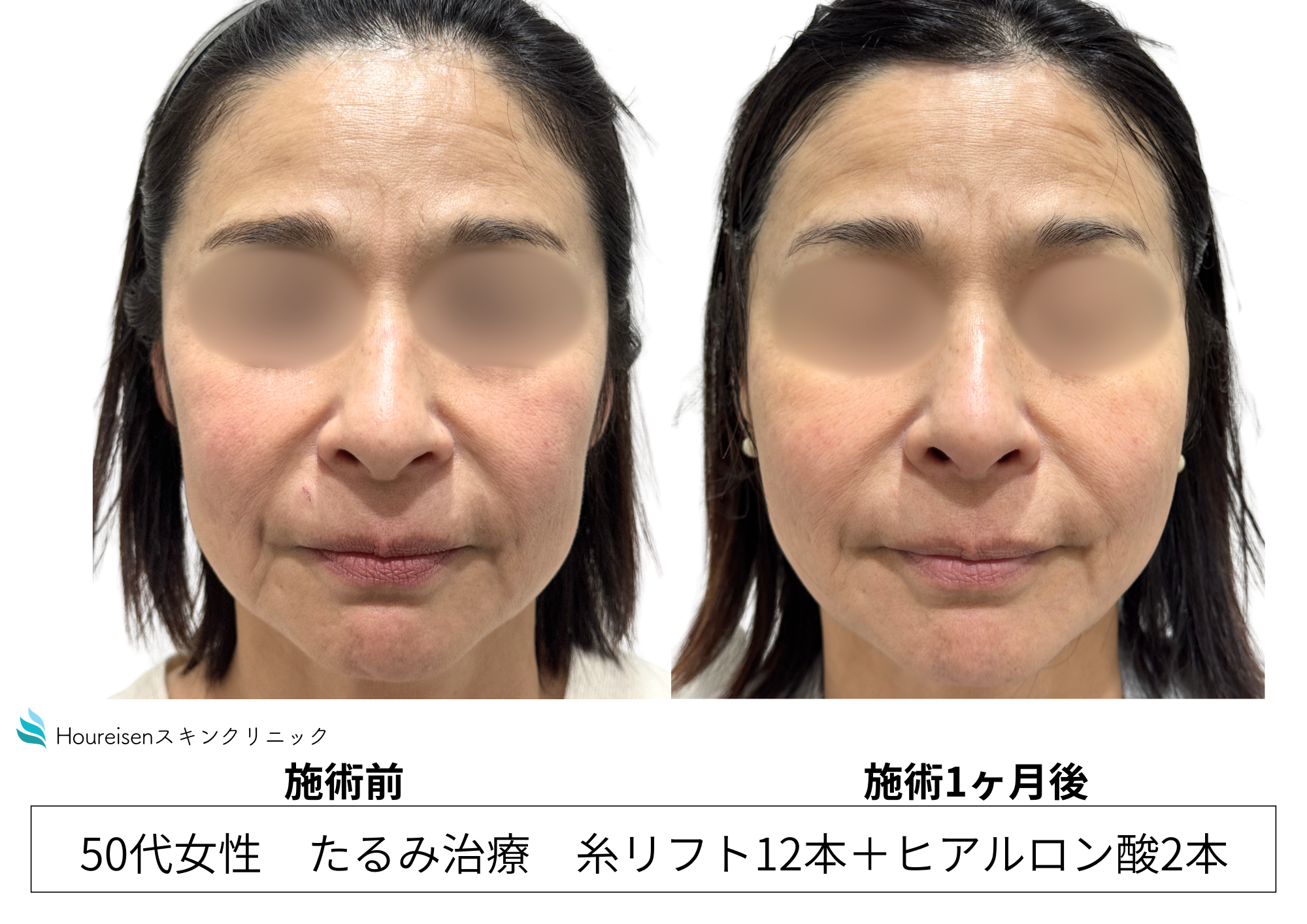 糸リフトとヒアルロン酸でたるみ・ほうれい線を自然に改善　50代女性症例㊲の症例写真