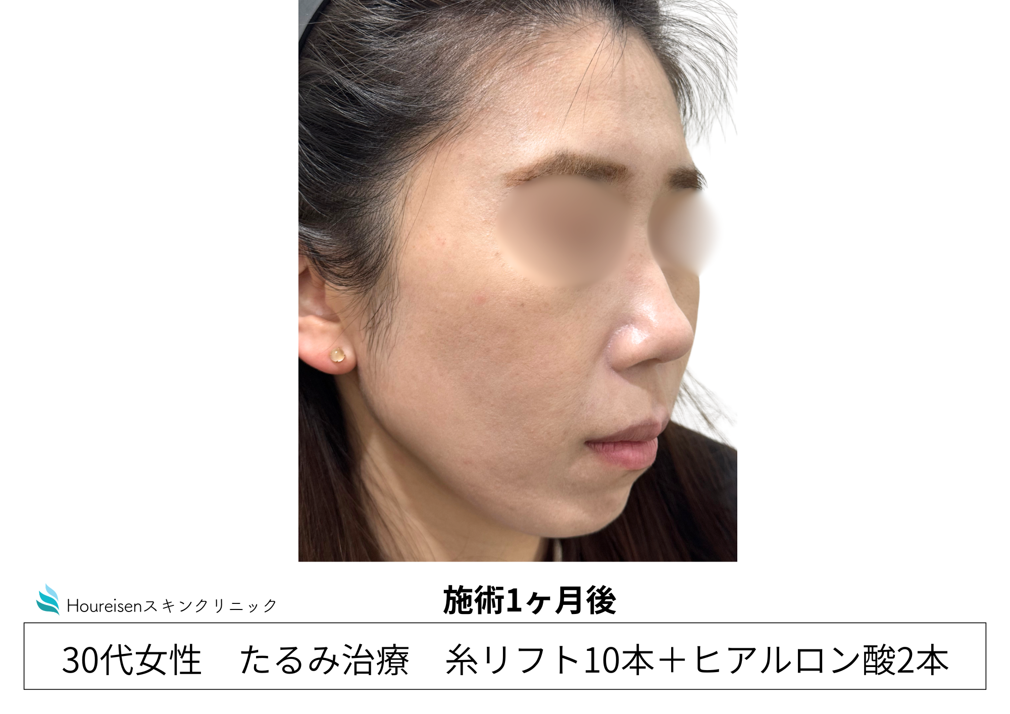 30代女性の糸リフトとヒアルロン酸施術1か月後 右側