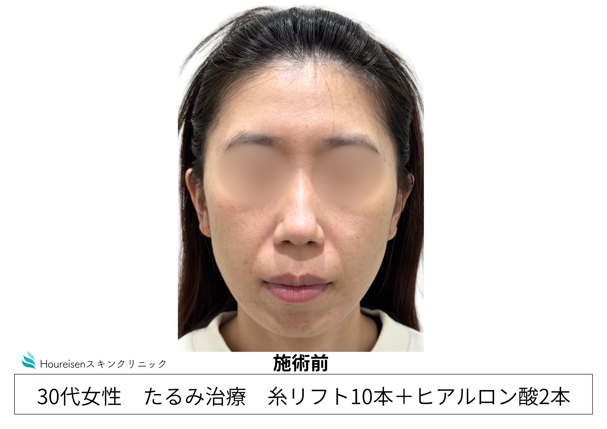 30代女性の糸リフトとヒアルロン酸施術前 正面
