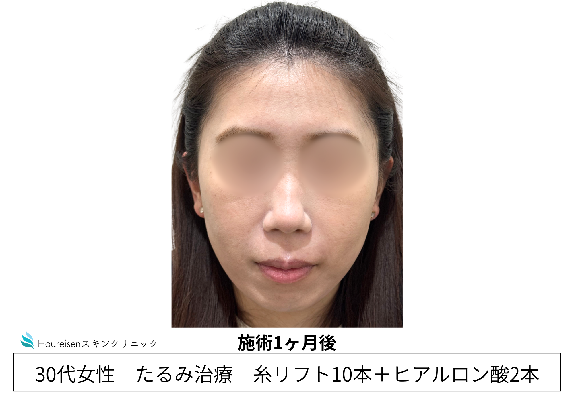 30代女性の糸リフトとヒアルロン酸施術1か月後 正面