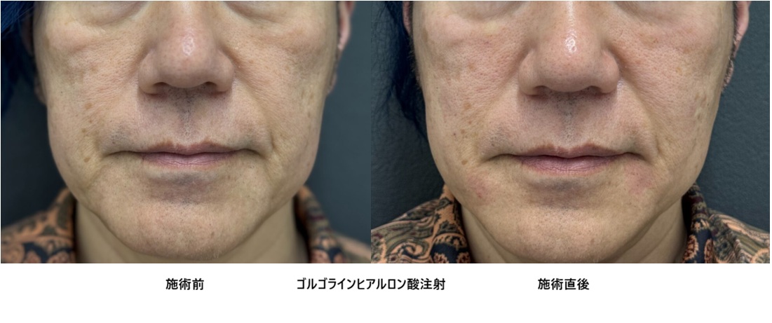 50代の男性にゴルゴラインにヒアルロン酸治療を行い自然に若返った症例⑨の症例写真