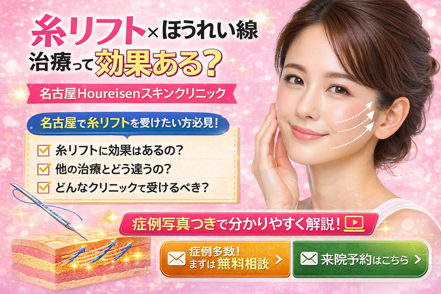 糸リフト×ほうれい線治療って効果ある？【名古屋Houreisenスキン 