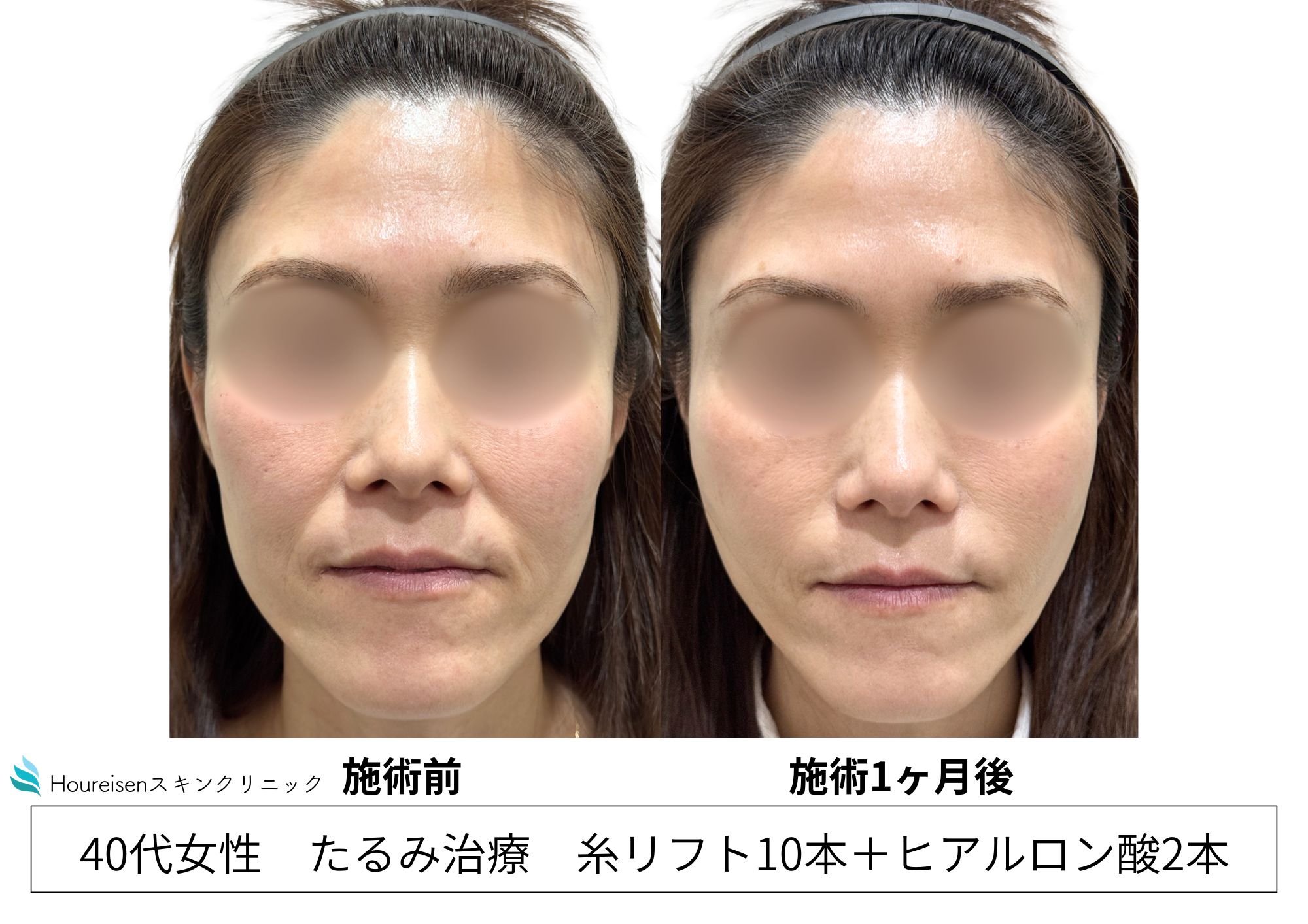 糸リフト×ヒアルロン酸でほうれい線・たるみを自然に改善　40代女性症例㉞の症例写真