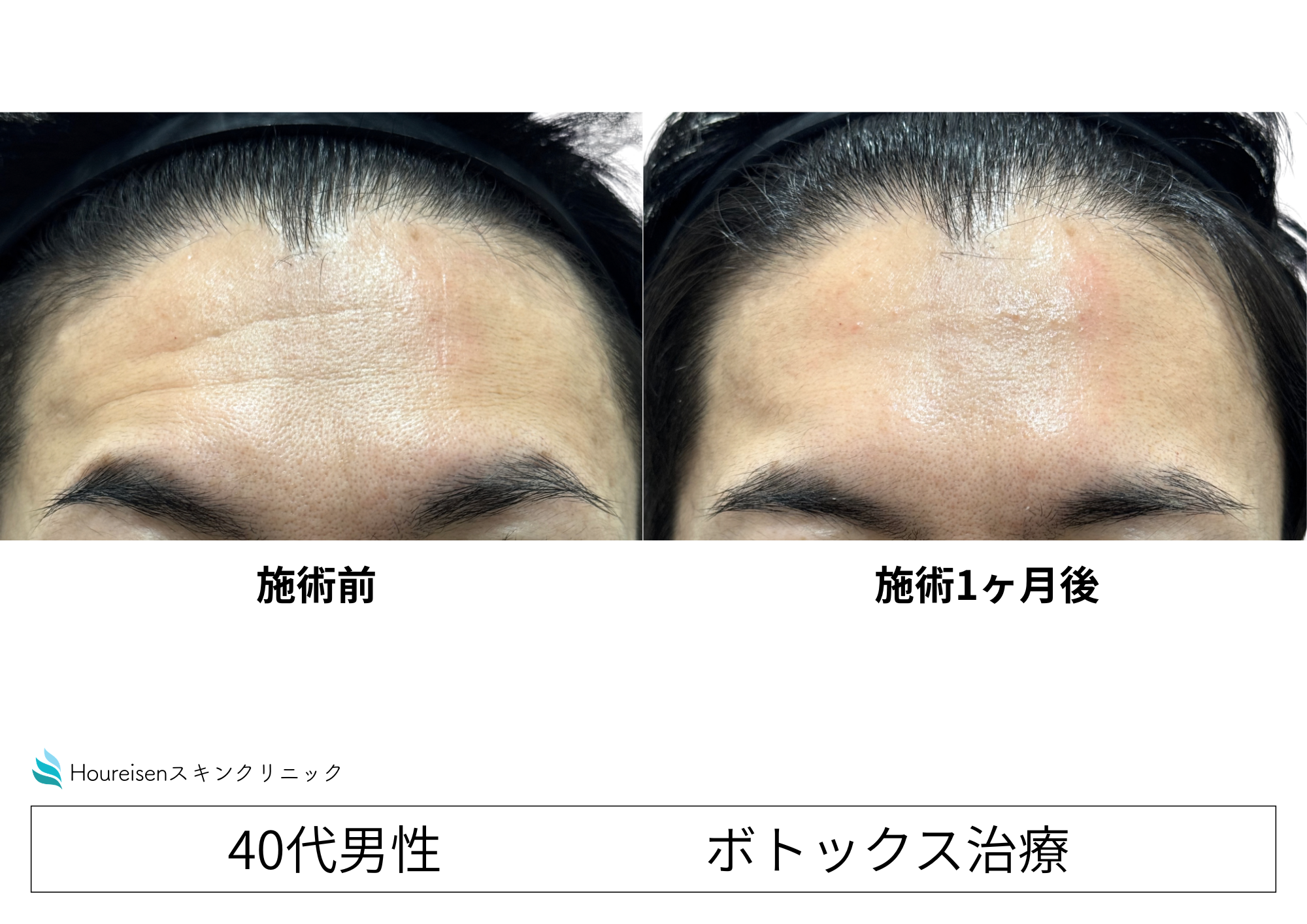 額・眉間の表情シワをボトックス治療で改善　40代男性症例②の症例写真
