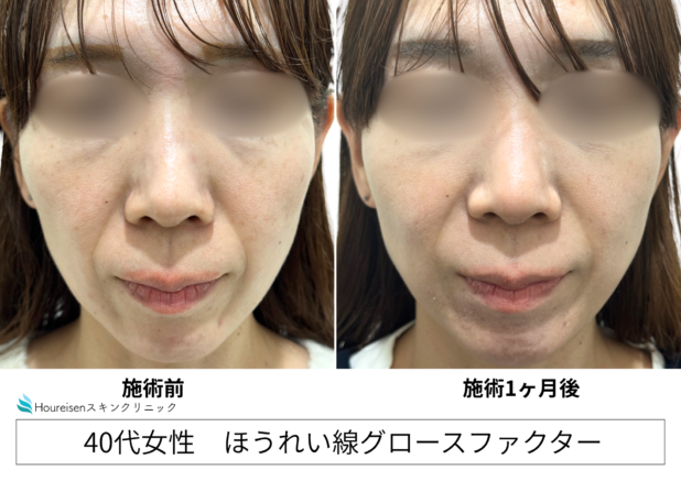 40代女性 症例55のほうれい線治療写真