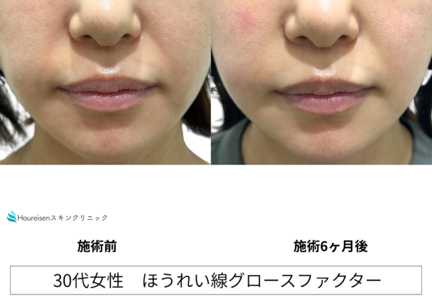 30代女性 症例49のほうれい線治療写真