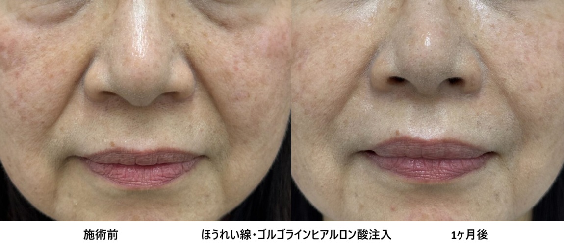 脱脂は少し不安だけど自然に若返りたい。目の下ほうれい線にヒアルロン酸注入で改善した50代女性㊷の症例写真