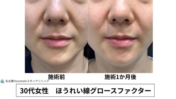 30代女性 症例63のほうれい線治療写真
