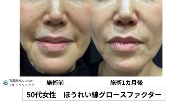 50代女性 症例47のほうれい線治療写真