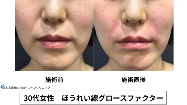 30代女性 症例59のほうれい線治療写真