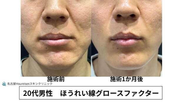 20代男性 症例6のほうれい線治療写真