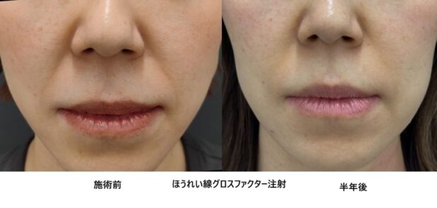 40代女性 症例57のほうれい線治療写真