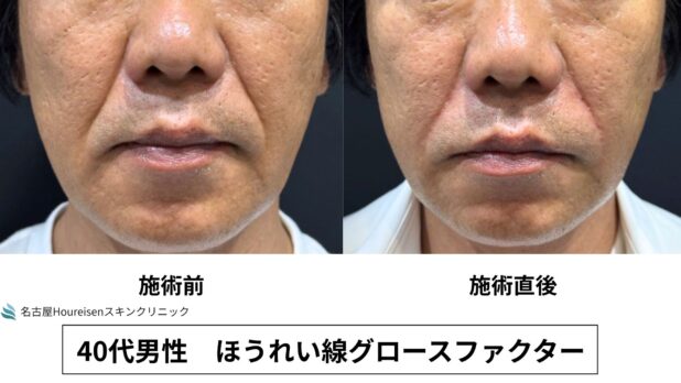 40代男性 症例9のほうれい線治療写真
