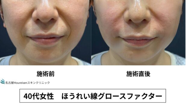 40代女性 症例58のほうれい線治療写真