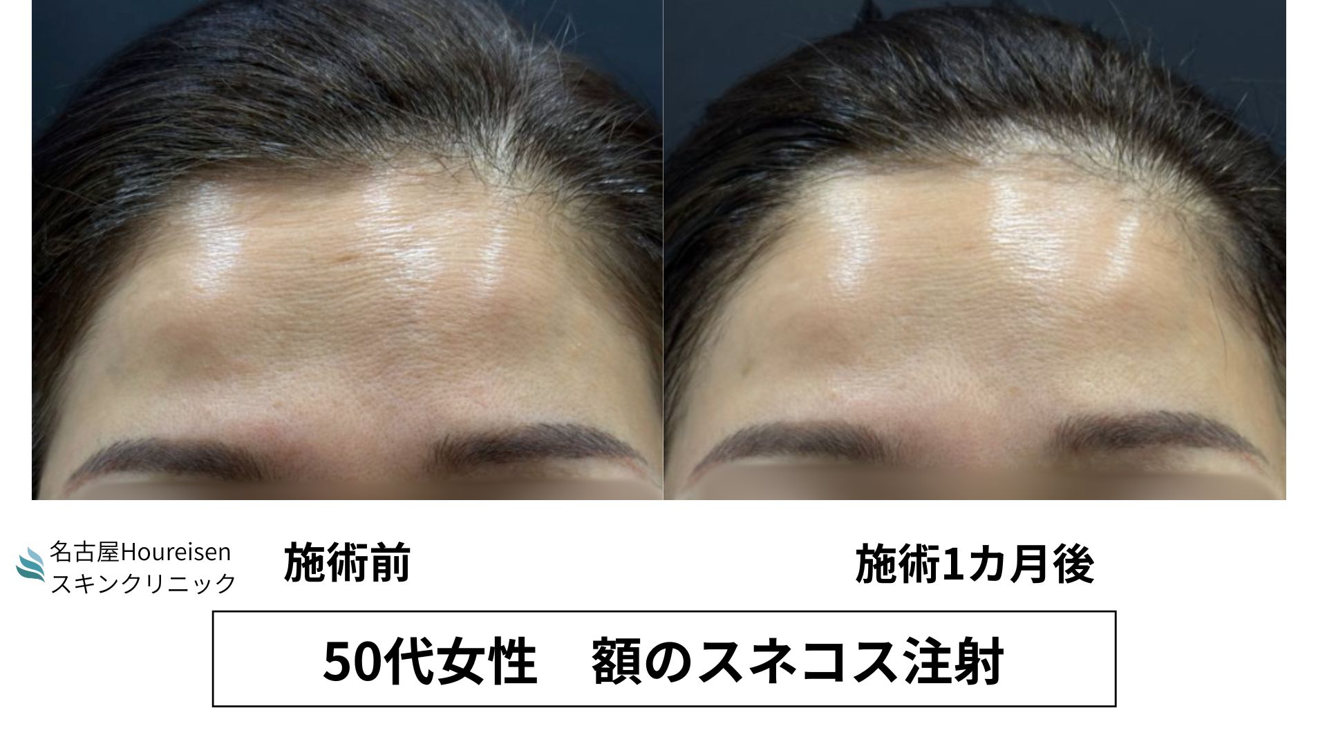 【名古屋】50代女性　額のスネコス注射で乾燥・小シワ・毛穴を改善　1か月後の経過の症例写真