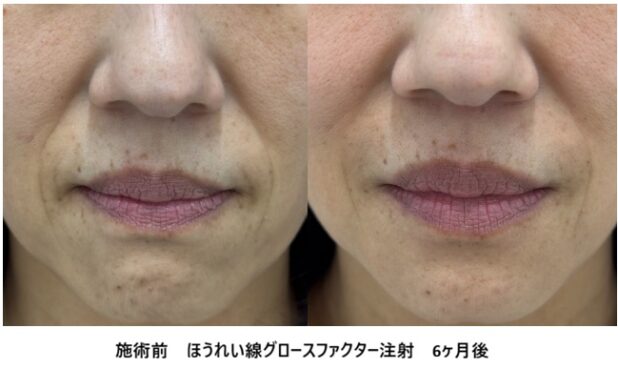 50代女性 症例45のほうれい線治療写真