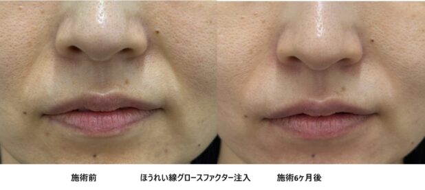 40代女性 症例64のほうれい線治療写真