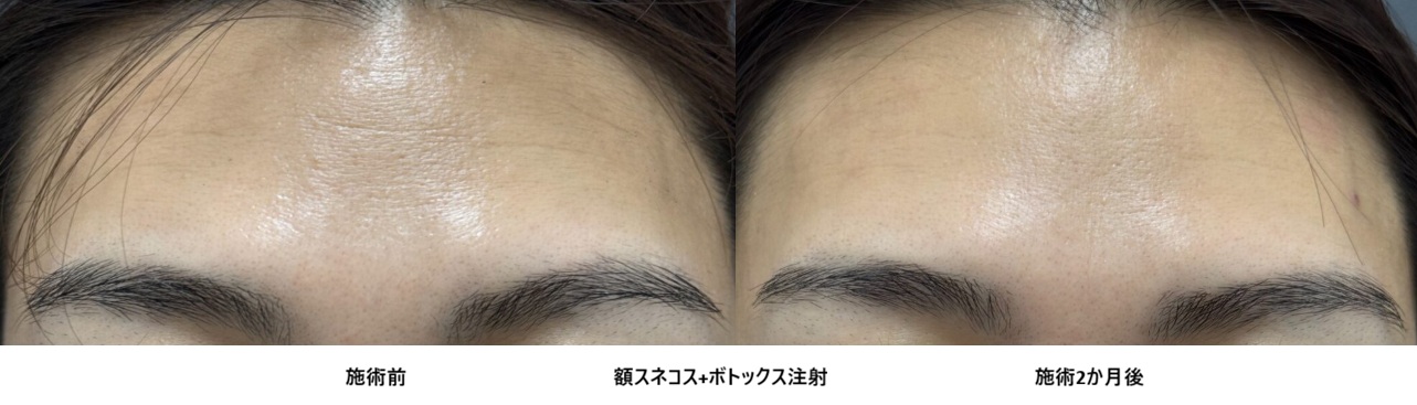 額のシワは“肌質×筋肉”で解決！30代女性のスネコス＋ボトックス症例④の症例写真