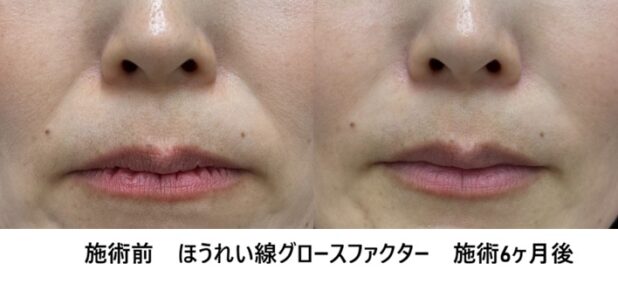 50代女性 症例46のほうれい線治療写真