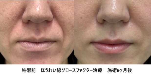 30代女性 症例58のほうれい線治療写真