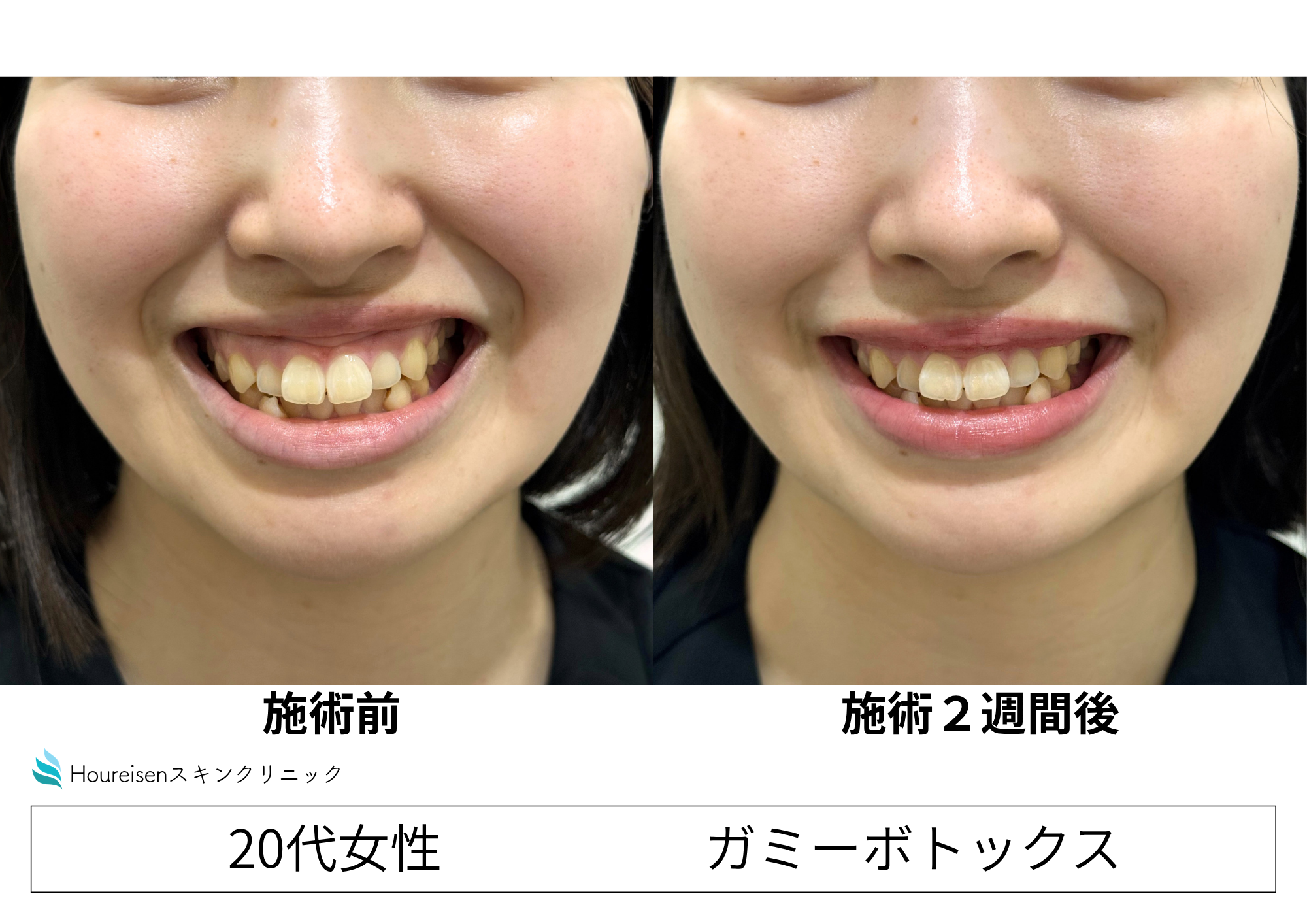 ガミーボトックス注射で歯茎の露出軽減　20代女性症例④の症例写真
