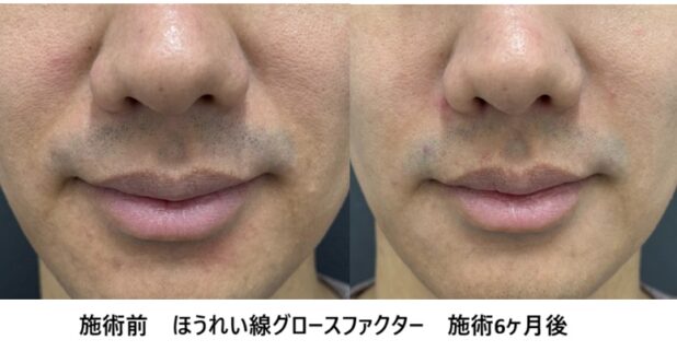 30代男性 症例13のほうれい線治療写真