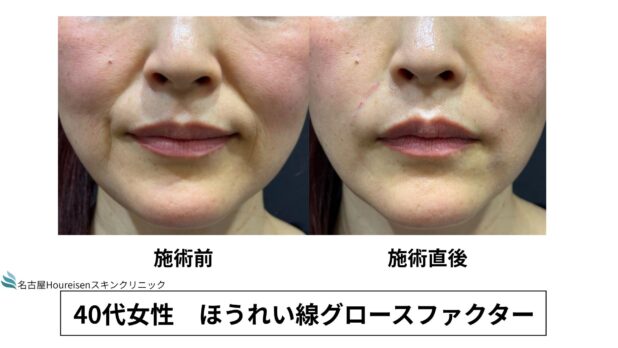 40代女性 症例60のほうれい線治療写真