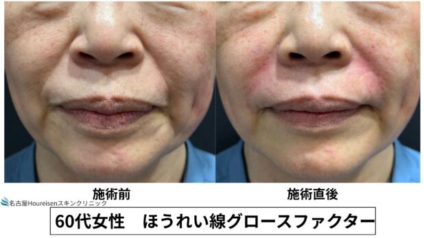 60代女性 症例12のほうれい線治療写真