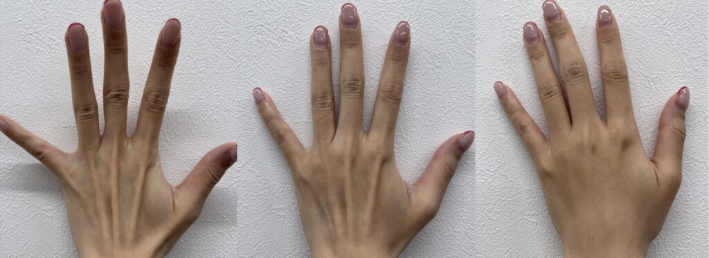 手の甲ヒアルロン酸注入前