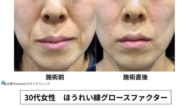 30代女性 症例60のほうれい線治療写真