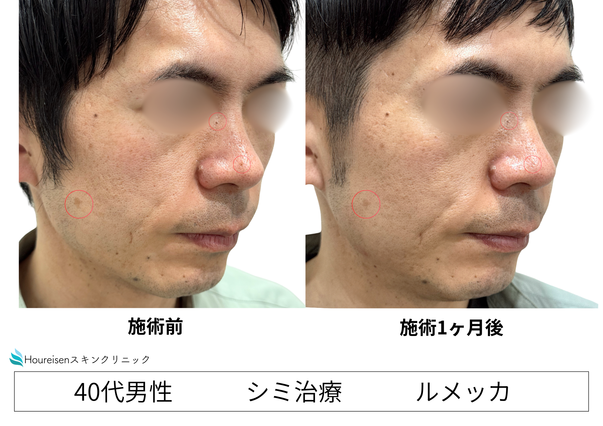 ダウンタイムを抑えたシミ治療（ルメッカ）　40代男性症例⑤の症例写真