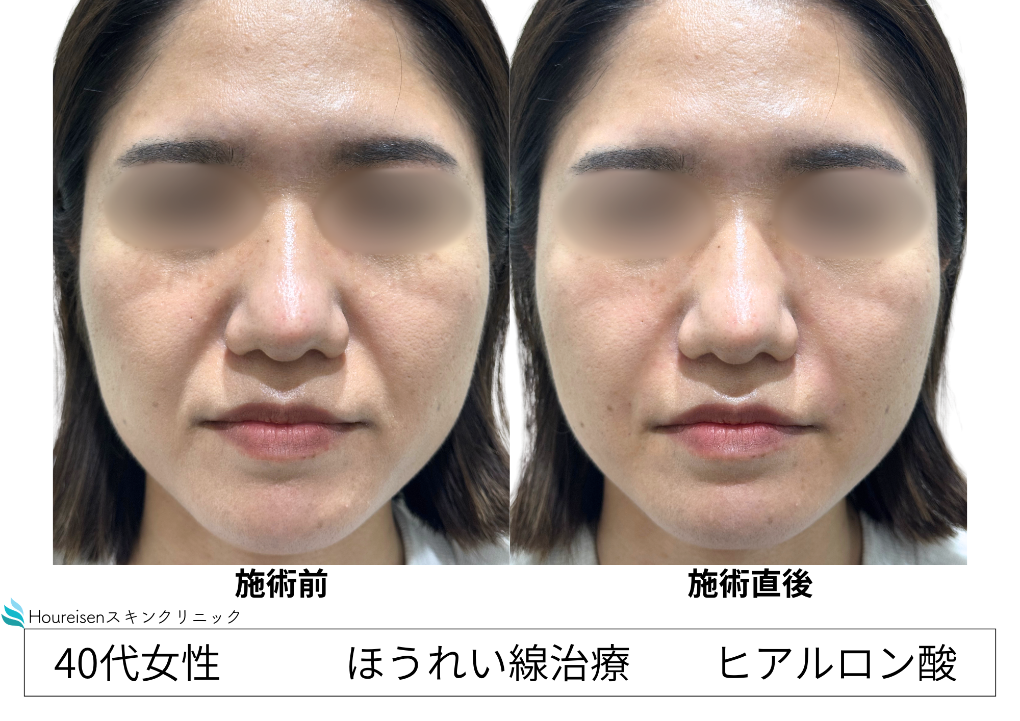 10代から悩んでいたほうれい線をヒアルロン酸で自然に改善 40代女性症例㊴の症例写真