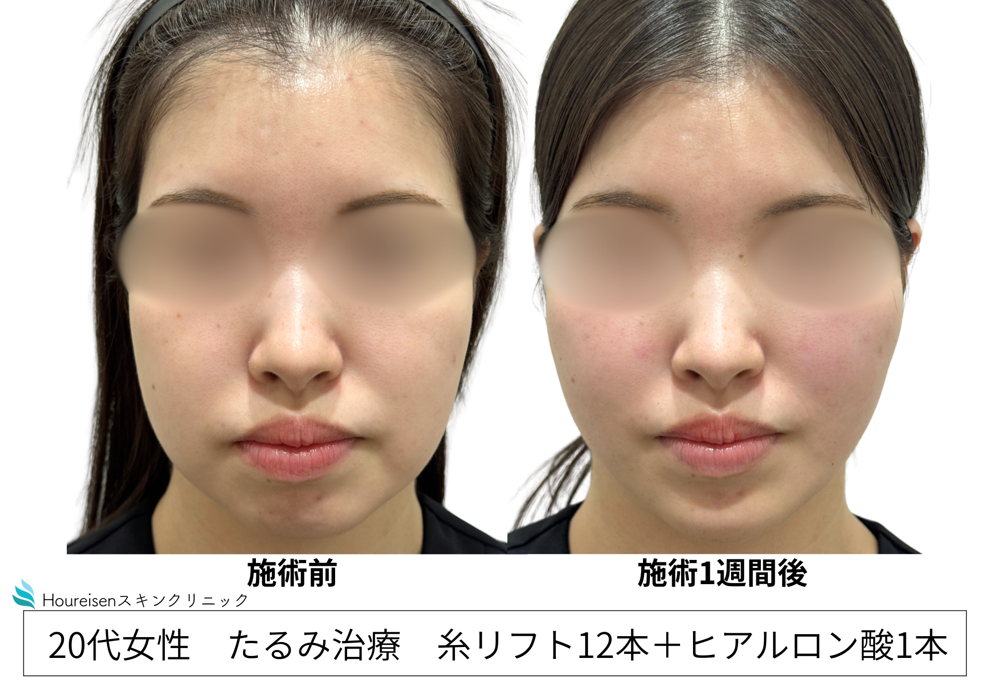 20代女性フェイスラインが変わるだけで印象が激変？！糸リフト＆ヒアルロン酸治療【40】の症例写真