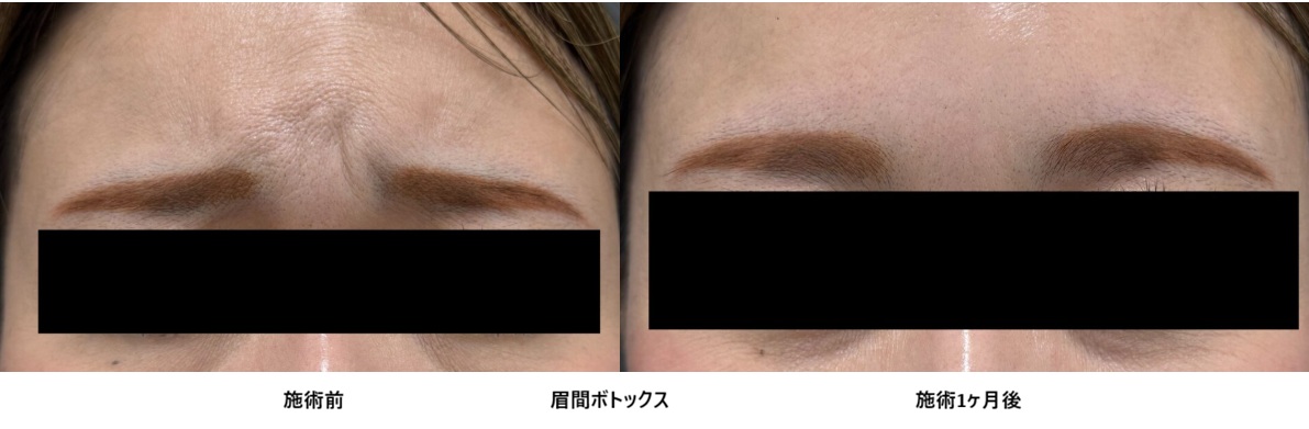 30代女性眉間のしわ撃退ボトックスの症例④の症例写真