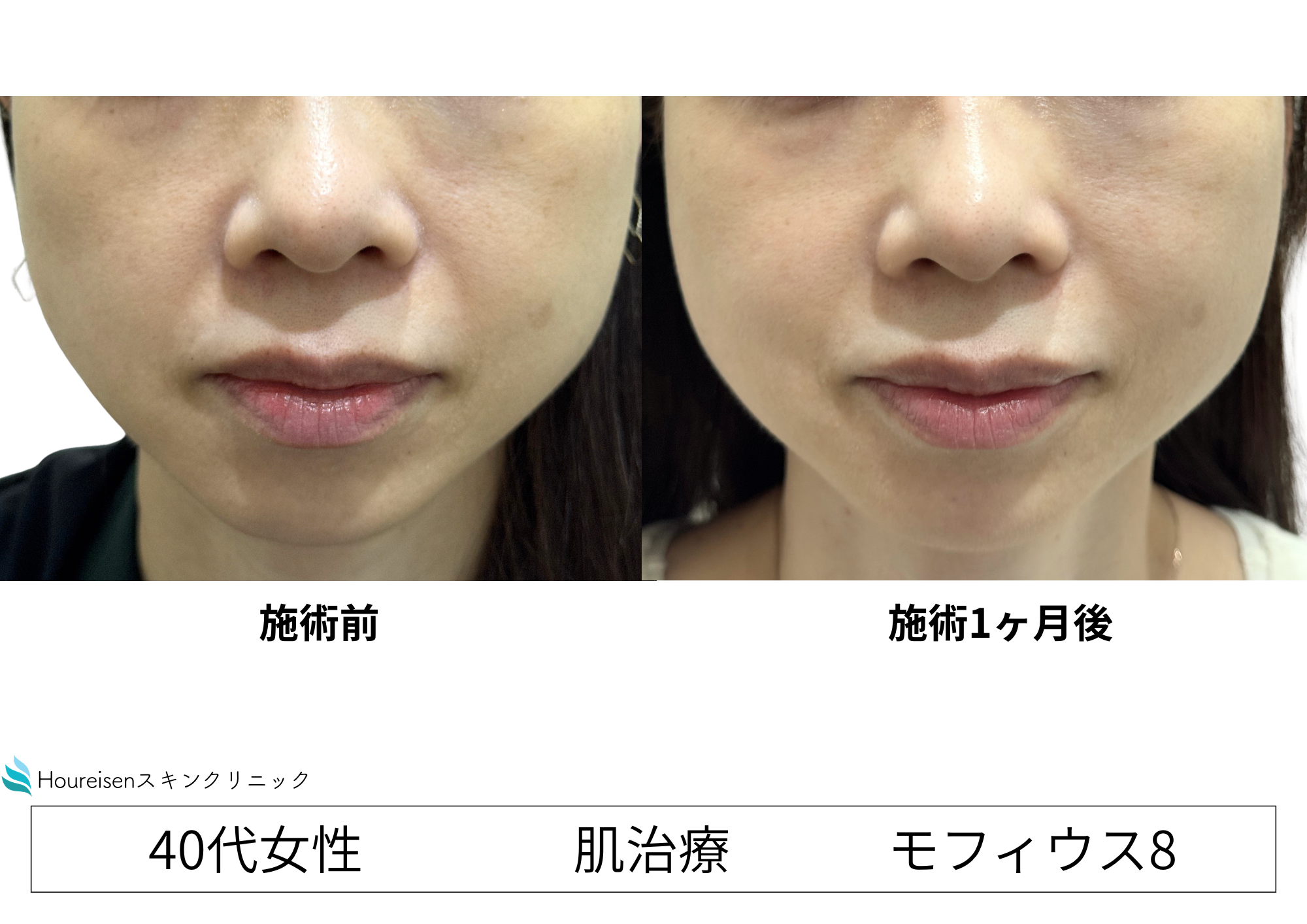 モフィウス8で毛穴・たるみを改善　40代女性症例①の症例写真