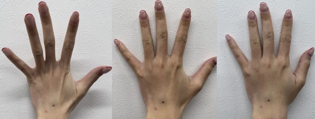 手の甲ヒアルロン酸注入後