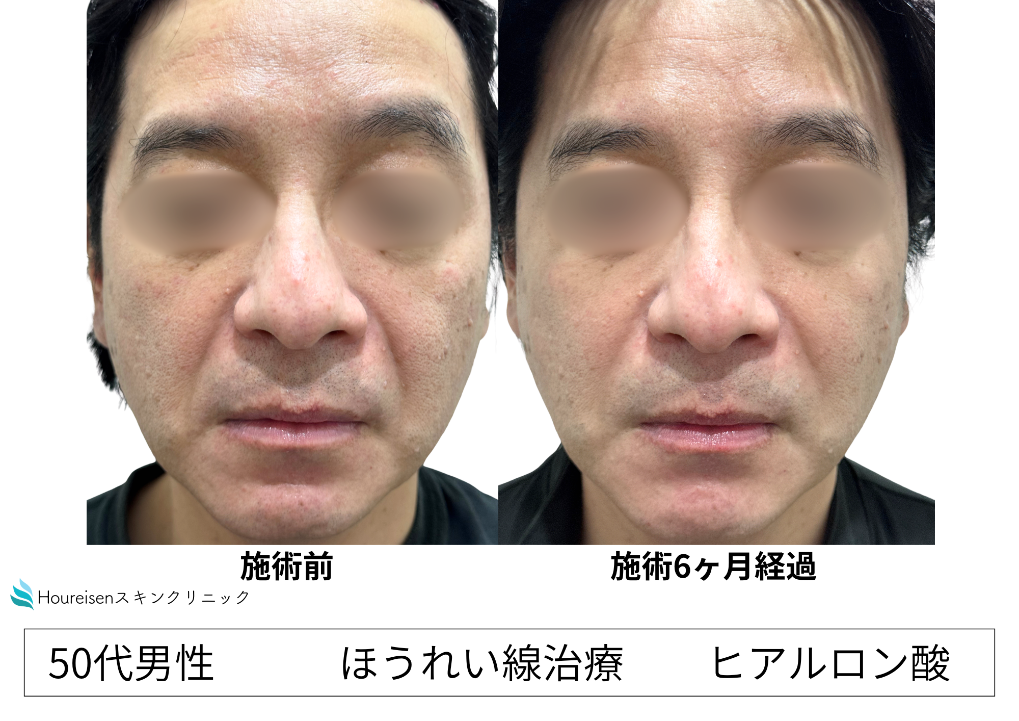 ヒアルロン酸注入治療後、半年経過しても自然な印象が継続 50代男性症例㊶の症例写真