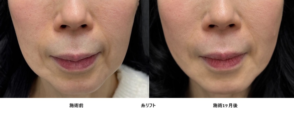 糸リフトでたるみ・ほうれい線を自然に改善　60代女性症例㊴の症例写真