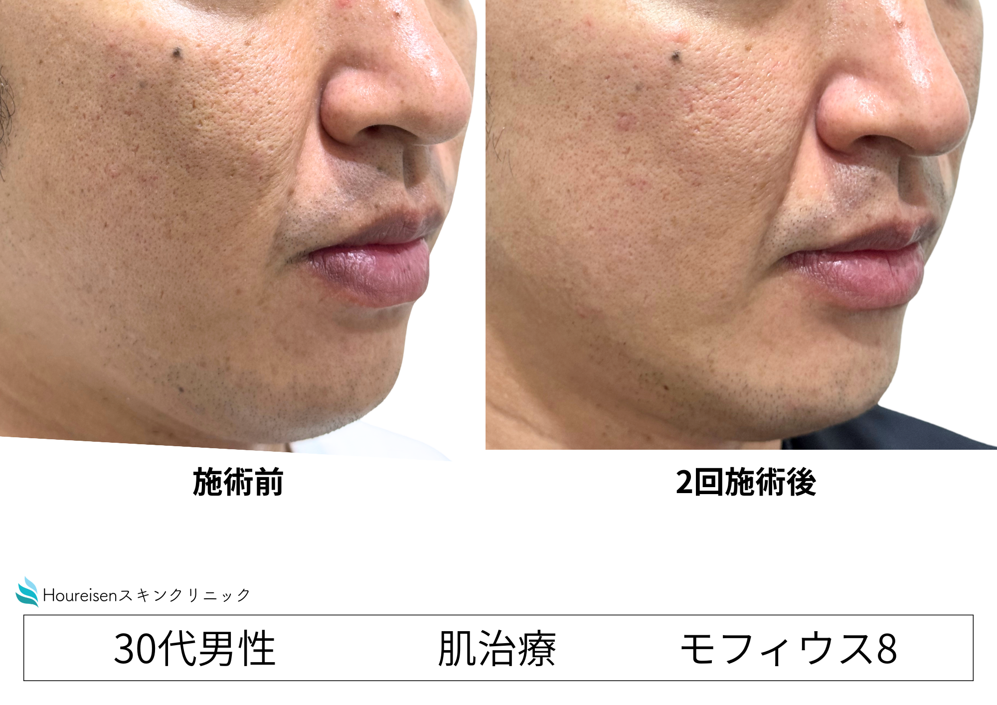 毛穴・ニキビ跡のクレータ―をモフィウス8治療で改善 30代男性症例②